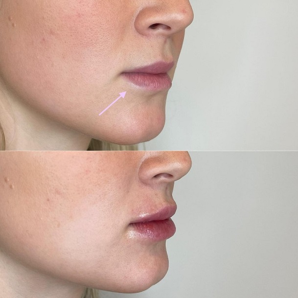 Fillers naturligt Stockholm